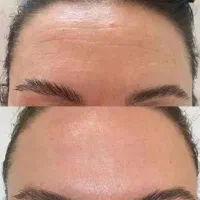 اف ویژه ژل بوتاکس پرسینگ|خدمات آرایشگری و زیبایی|شیراز, شهرک مطهری|دیوار