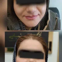 تزریق ژل طبیعی فیلر بوتاکس(کلینیک زیبایی گلد)|خدمات آرایشگری و زیبایی|سنندج, |دیوار