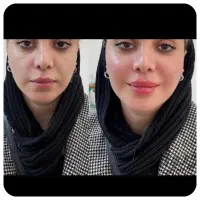 تزریق تخصصی فیلر، بوتاکس، ژل ، مطب زیبایی|خدمات زیبایی و سلامت|شیراز, سینما سعدی|دیوار