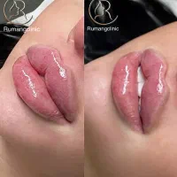 فیلر بوتاکس پلاسماجت پیرسینگ میکرونیدلینگ