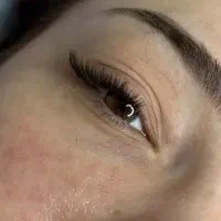 اکسیشن مژه همراه با کاشت هیدن موقت پنبه ای