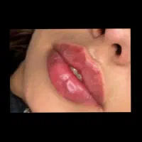 تزریق ژل بوتاکس آنزیم مزو ، خدمات پیرسینگ پرسینگ