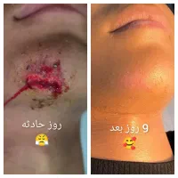 لیفت شقیقه،جای زخم(اسکار) بلفاروبوتاکس فیلر|خدمات آرایشگری و زیبایی|اهواز, زیتون کارگری|دیوار