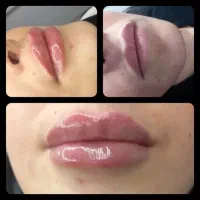 ژل وبوتاکس۴۹۰|خدمات زیبایی و سلامت|کرج, عظیمیه|دیوار