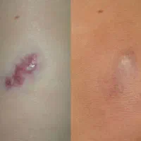 افرتابستانه از بین بردن تخصص جای جوش و اسکار پوستی|خدمات آرایشگری و زیبایی|شیراز, باهنر|دیوار