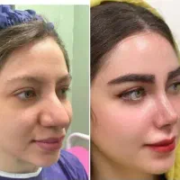 عمل جراحی بینی فقط 26 درکرج بدون تامپون(ENT)|خدمات آرایشگری و زیبایی|کرج, جهانشهر|دیوار