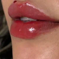 ژل و بوتاکس بصورت نقد و چکی