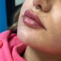 تزریق فیلر لب با متدهای ترند اینستا - دکتر واحدی|خدمات آرایشگری و زیبایی|قزوین, |دیوار