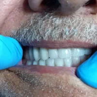 دندان مصنوعی/دندانسازی