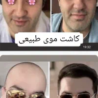 کاشت مو فقط 6 میلیون تومان به مدت محدود|خدمات آرایشگری و زیبایی|شیراز, زرگری|دیوار