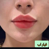 خدمات تخصصی تزریق ژل و بوتاکس|خدمات آرایشگری و زیبایی|فولادشهر, C3|دیوار