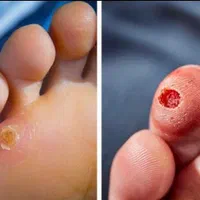 خالبرداری ،رفع کک ومک ،برداشتن میخچه توسط پزشک|خدمات آرایشگری و زیبایی|کرج, شهرک یاس جنوبی|دیوار