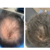 مزو رشدمو لاغری کاملارایگان،ژل بوتاکس انزیم