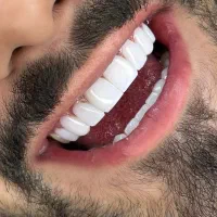 کامپوزیت زیبایی دندان یاسوج