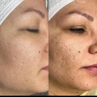 درمان همیشگی تورفتگی پوستی/ جای جوش/اسکار/سالک|خدمات آرایشگری و زیبایی|اصفهان, احمدآباد|دیوار