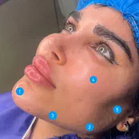 اقساط10ماه‌تزریق چربی ژل‌لب/هیپ‌دیپ/باسن/غبغب/صورت