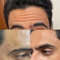 ژل بوتاکس تزریق چربی پی ارپی انزیم مزوتراپ