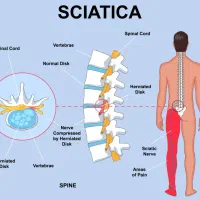 درمان تخصصی و غیرجراحی سیاتیک