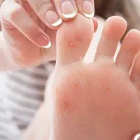 زگیل خال گوشتی و مخچه و...|خدمات آرایشگری و زیبایی|سرپل ذهاب, |دیوار