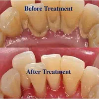 جرمگیری دندان