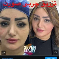 ساکشن و تزریق چربی