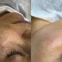 درمان لک / پی ارپی/پیری پوست/ تااخر هفته ۹۸۰/محدود|خدمات آرایشگری و زیبایی|رشت, معلم|دیوار
