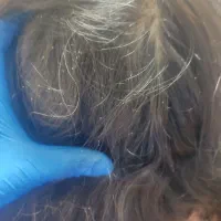 پاکسازی رشک و شپش صددرصد تضمینی وگیاهی