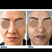 مزوندلینگ ،میکرونیلدینگ و درمان تخصصی لک|خدمات آرایشگری و زیبایی|بیرجند, |دیوار