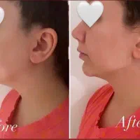 جشنواره زیبایی((مدل ژل وبوتاکس))|خدمات آرایشگری و زیبایی|سنندج, |دیوار