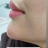 فیلر بوتاکس