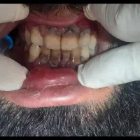 انجام جرمگیری هر فک فقط ۴۵۰ تومان در مطب شخصی|خدمات آرایشگری و زیبایی|زاهدان, |دیوار