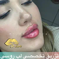 تزریق ژل بوتاکس زاویه فک گونه شقیقه فیلرلب روسی|خدمات آرایشگری و زیبایی|تهران, پونک|دیوار