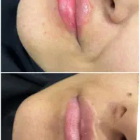 ژل بوتاکس و انزیم|خدمات آرایشگری و زیبایی|شیراز, لشکری‎|دیوار