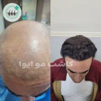 کاشت مو