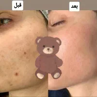 هر نوع پوستی قابل درمانه (تضمینی )