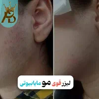 لیزر مو زائد مادام العمر و تضمینی مایا بیوتی|خدمات آرایشگری و زیبایی|یاسوج, |دیوار