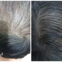 با تونیک ضدریزش آریا موهای ریختتو برگردون