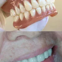 دندان مصنوعی شهر محلات تحویل ۵ ساعته،7/900، فاکتور