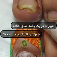 درمان بیماری های ناخن بدون جراحی درکلینیک|خدمات آرایشگری و زیبایی|قرچک, مهدیه|دیوار