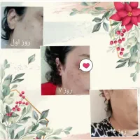 برداشت خال و لک و زگیل تضمینی