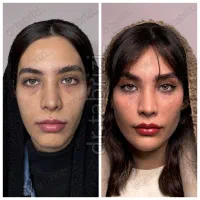 فیلر ژل بوتاکس فیلرلب بینی پوست مو کانتورینگ