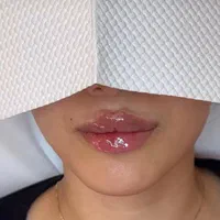 تزریق ژل صورت