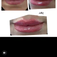 دوره آموزش ژل بوتاکس فیلر و زیبایی