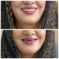 دندان مصنوعی با اقساط 10 ماهه(بدون سود)