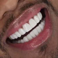 مگه میشه کامپوزیت دندان با این قیمت +هدیه|خدمات آرایشگری و زیبایی|کرج, فاز ۳ گوهردشت|دیوار