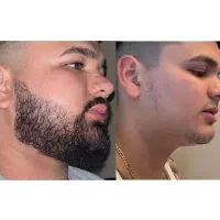 ضخامت تار ریش  و سبیل