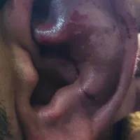 ترمیم گوش شکسته