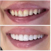 جشنواره کامپوزیت دندان از واحدی 800تومن شروع قیمت|خدمات آرایشگری و زیبایی|صفادشت, |دیوار