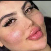 تزریق ژل و بوتاکس بدون درد و کبودی|خدمات آرایشگری و زیبایی|بروجن, |دیوار