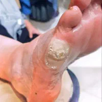 برداشتن خال زیگیل ومیخچه دست پابامحلول گیاهی|خدمات آرایشگری و زیبایی|نیشابور, بنیاد شهید|دیوار